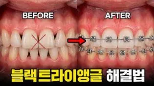 thumb 2038849015 OdmA4uyz 8fe8225c0d174521e3ce76fe4f6affbc5cc595eb 315x176 — 루센트치과의원